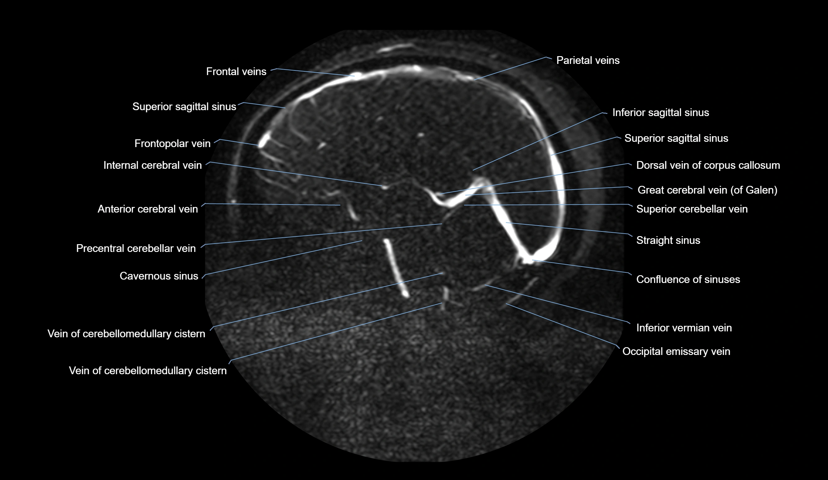 MRV brain sagittal anatomy 3T MRI images -img-01015-00042.webp